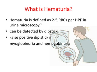 What is Hematuria?
• Hematuria is defined as 2-5 RBCs per HPF in
urine microscopy.1
• Can be detected by dipstick.
• False positive dip stick in
myoglobinuria and hemogobinuria
 