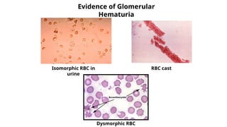 Isomorphic Rbs Comprehensive Approach to Hematuria in Children: Diagnosis and ...