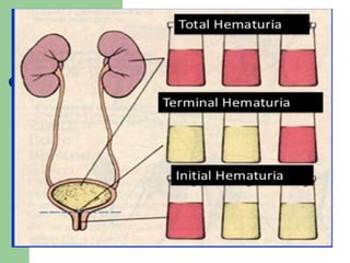 Approach to hematuria - general | PPTX