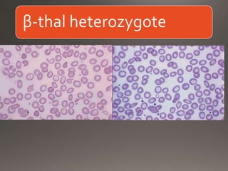 β-thal heterozygote
 