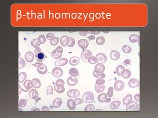 β-thal homozygote
 