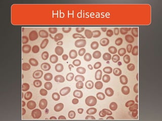 Hb H disease
 