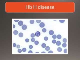 Hb H disease
 