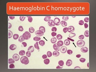 Haemoglobin C homozygote
 