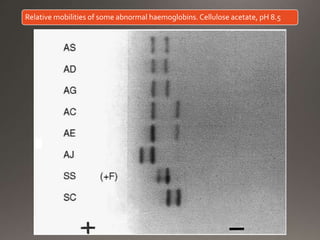 Relative mobilities of some abnormal haemoglobins. Cellulose acetate, pH 8.5
 