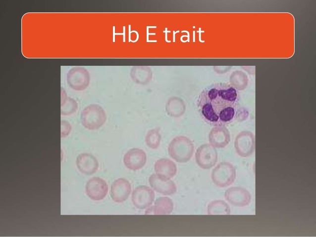 Hemoglobin Disease Hemoglobinopathies Lab diagnosis