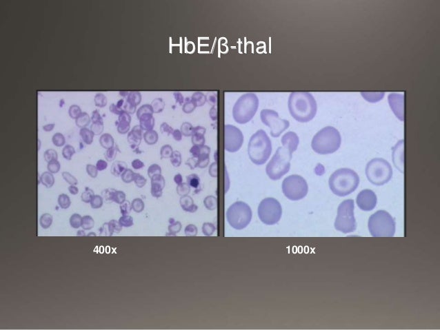 Hemoglobin Disease Hemoglobinopathies Lab diagnosis