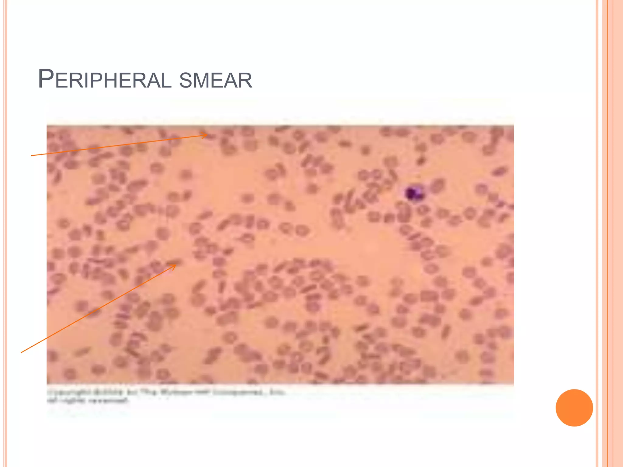 PERIPHERAL SMEAR
 