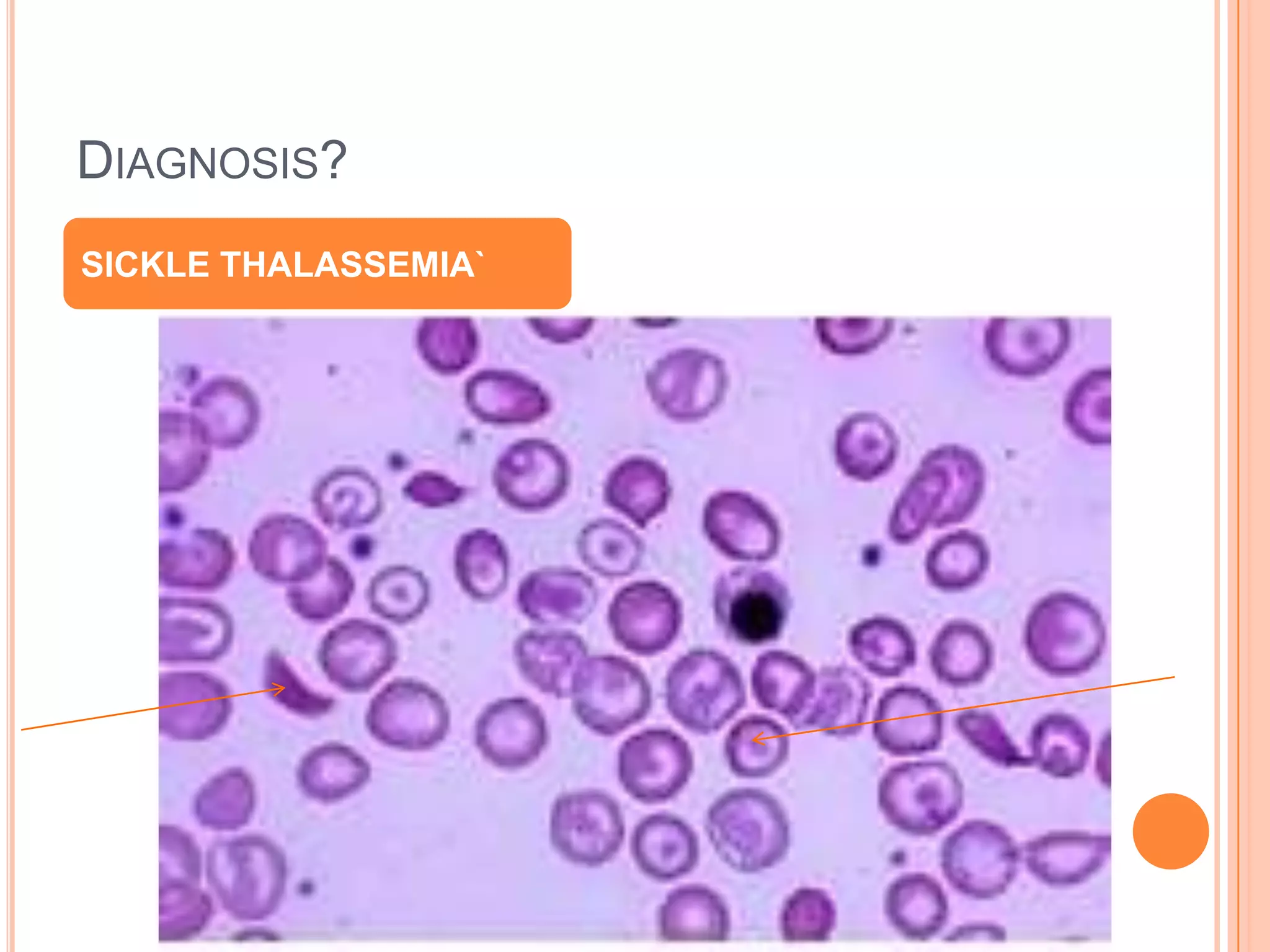 DIAGNOSIS?
SICKLE THALASSEMIA`
 
