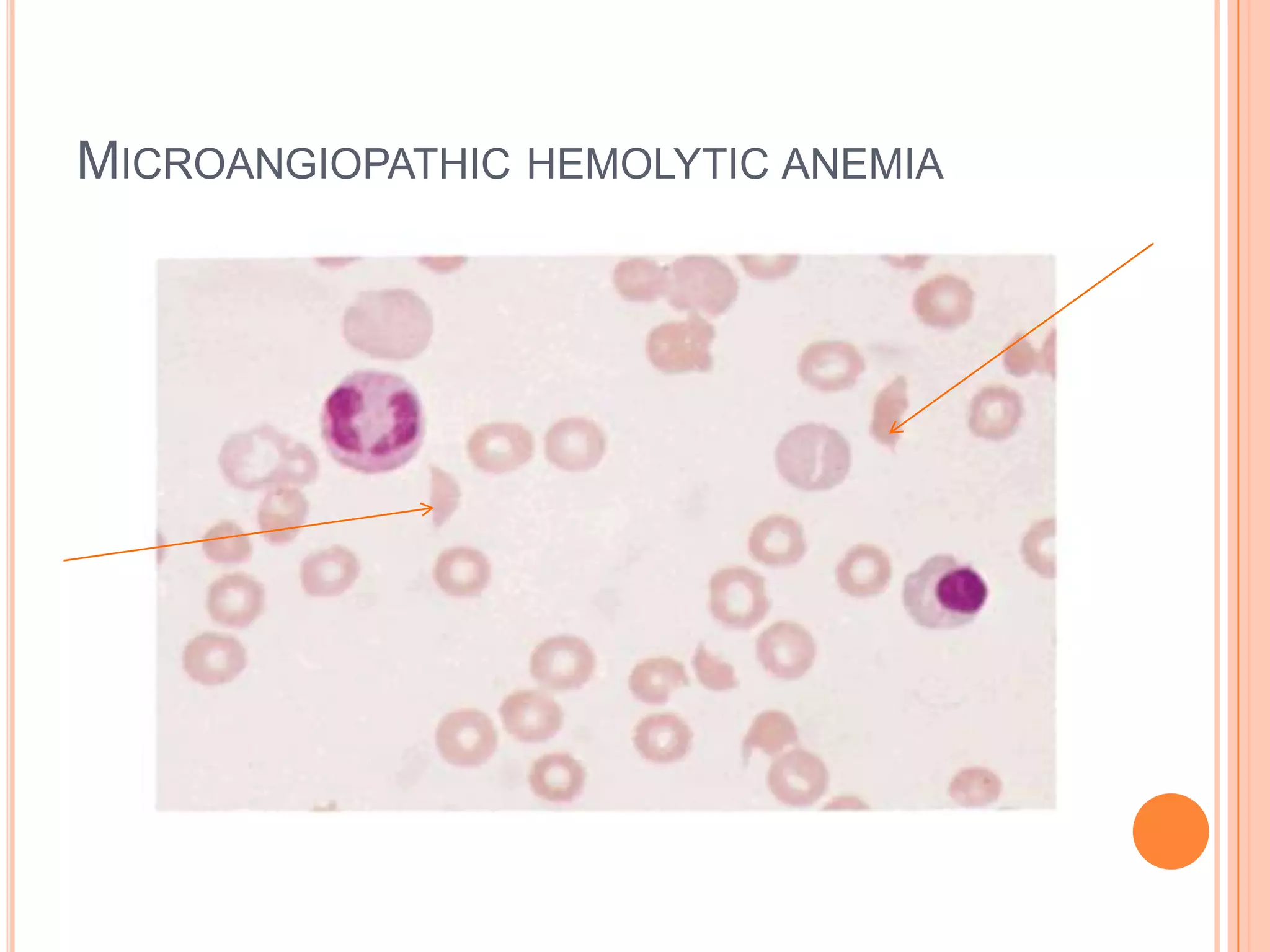 MICROANGIOPATHIC HEMOLYTIC ANEMIA
 