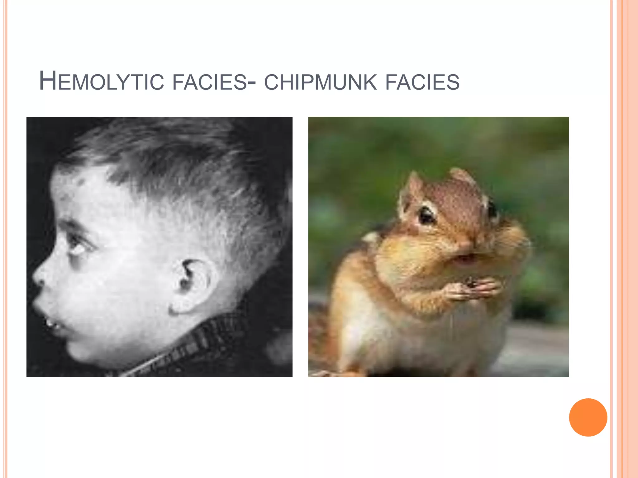 HEMOLYTIC FACIES- CHIPMUNK FACIES
 