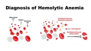 Diagnosis of Hemolytic Anemia
 