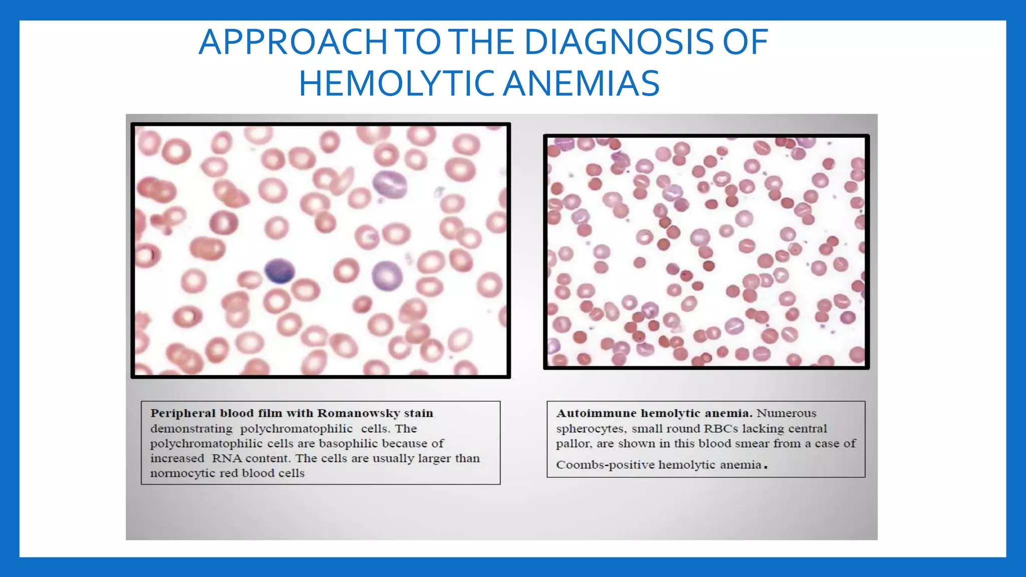 APPROACHTOTHE DIAGNOSIS OF
HEMOLYTIC ANEMIAS
 