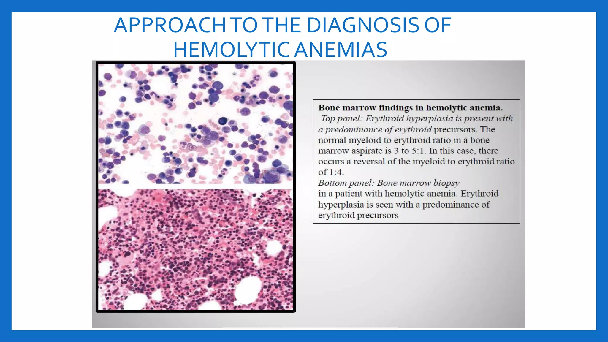 APPROACHTOTHE DIAGNOSIS OF
HEMOLYTIC ANEMIAS
 