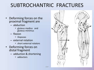 SUBTROCHANTRIC FRACTURES
• Deforming forces on the
proximal fragment are
– abduction
• gluteus medius and
gluteus minimus
– flexion
• iliopsoas
– external rotation
• short external rotators
• Deforming forces on
distal fragment
– adduction & shortening
• adductors
UMY
 