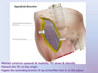 Retract sartorius upwards & medially; TFL down & laterally
Detach the TFL at iliac origin.
Ligate the ascending branch of Lat.circumflex Fem A. in this plane.UMY
 