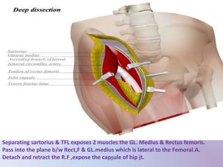Separating sartorius & TFL exposes 2 muscles the GL. Medius & Rectus femoris.
Pass into the plane b/w Rect,F & GL.medius which is lateral to the Femoral.A.
Detach and retract the R.F ,expose the capsule of hip jt.UMY
 