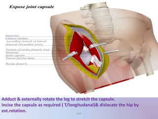 Adduct & externally rotate the leg to stretch the capsule.
Incise the capsule as required ( T/longitudanal)& dislocate the hip by
ext.rotation. UMY
 
