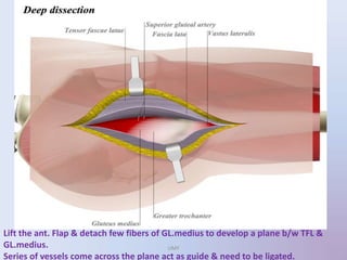 Lift the ant. Flap & detach few fibers of GL.medius to develop a plane b/w TFL &
GL.medius.
Series of vessels come across the plane act as guide & need to be ligated.
UMY
 