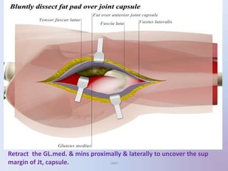 Retract the GL.med. & mins proximally & laterally to uncover the sup
margin of Jt, capsule. UMY
 
