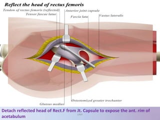 Detach reflected head of Rect.F from Jt. Capsule to expose the ant. rim of
acetabulum
UMY
 