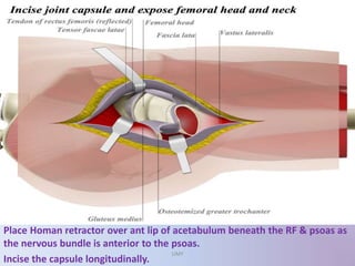 Place Homan retractor over ant lip of acetabulum beneath the RF & psoas as
the nervous bundle is anterior to the psoas.
Incise the capsule longitudinally.
UMY
 