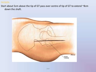 INCISION:
Start about 5cm above the tip of GT pass over centre of tip of GT to extend ~8cm
down the shaft.
UMY
 