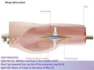 DEEPDISSECTION:
Split the GL. Medius starting in the middle of GT.
Don’t go beyond 3cm up the GT.to preserve sup.GL.N.
Split the fibers of V.lats at the base of the GT,UMY
 