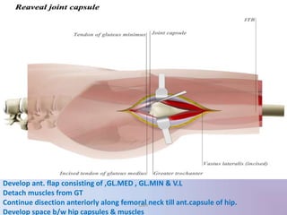 Develop ant. flap consisting of ,GL.MED , GL.MIN & V.L
Detach muscles from GT
Continue disection anteriorly along femoral neck till ant.capsule of hip.
Develop space b/w hip capsules & muscles
UMY
 