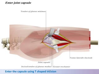 Enter the capsule using T shaped incisionUMY
 