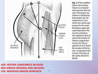 C
ADE- KOCHER LANGENBECK INCISION
BDE-GIBSON ORIGINAL SKIN INCISION
CDE- MODIFIED GIBSON APPROACH UMY
 