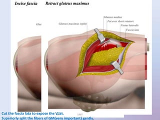 Cut the fascia lata to expose the V.lat.
Superiorly split the fibers of GM(very important) gently.
UMY
 