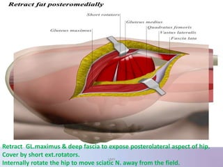Retract GL.maximus & deep fascia to expose posterolateral aspect of hip.
Cover by short ext.rotators.
Internally rotate the hip to move sciatic N. away from the field.
UMY
 
