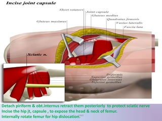 Detach piriform & obt.internus retract them posteriorly to protect sciatic nerve
Incise the hip jt, capsule , to expose the head & neck of femur.
Internally rotate femur for hip dislocation.UMY
 