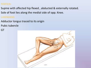 POSITION:
Supine with affected hip flexed , abducted & externally rotated.
Sole of foot lies along the medial side of opp. Knee.
LANDMARKS:
Adductor longus traced to its origin
Pubic tubercle
GT
UMY
 