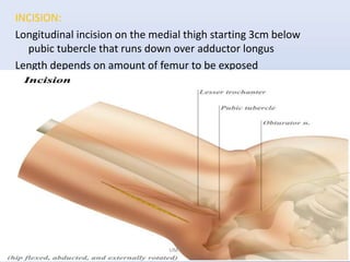 INCISION:
Longitudinal incision on the medial thigh starting 3cm below
pubic tubercle that runs down over adductor longus
Length depends on amount of femur to be exposed
UMY
 