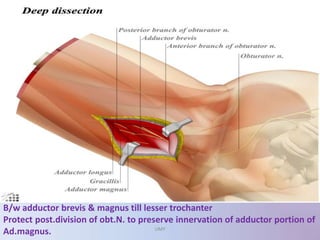 B/w adductor brevis & magnus till lesser trochanter
Protect post.division of obt.N. to preserve innervation of adductor portion of
Ad.magnus. UMY
 
