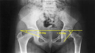 Approach to hip joint pain in childhood | PPTX