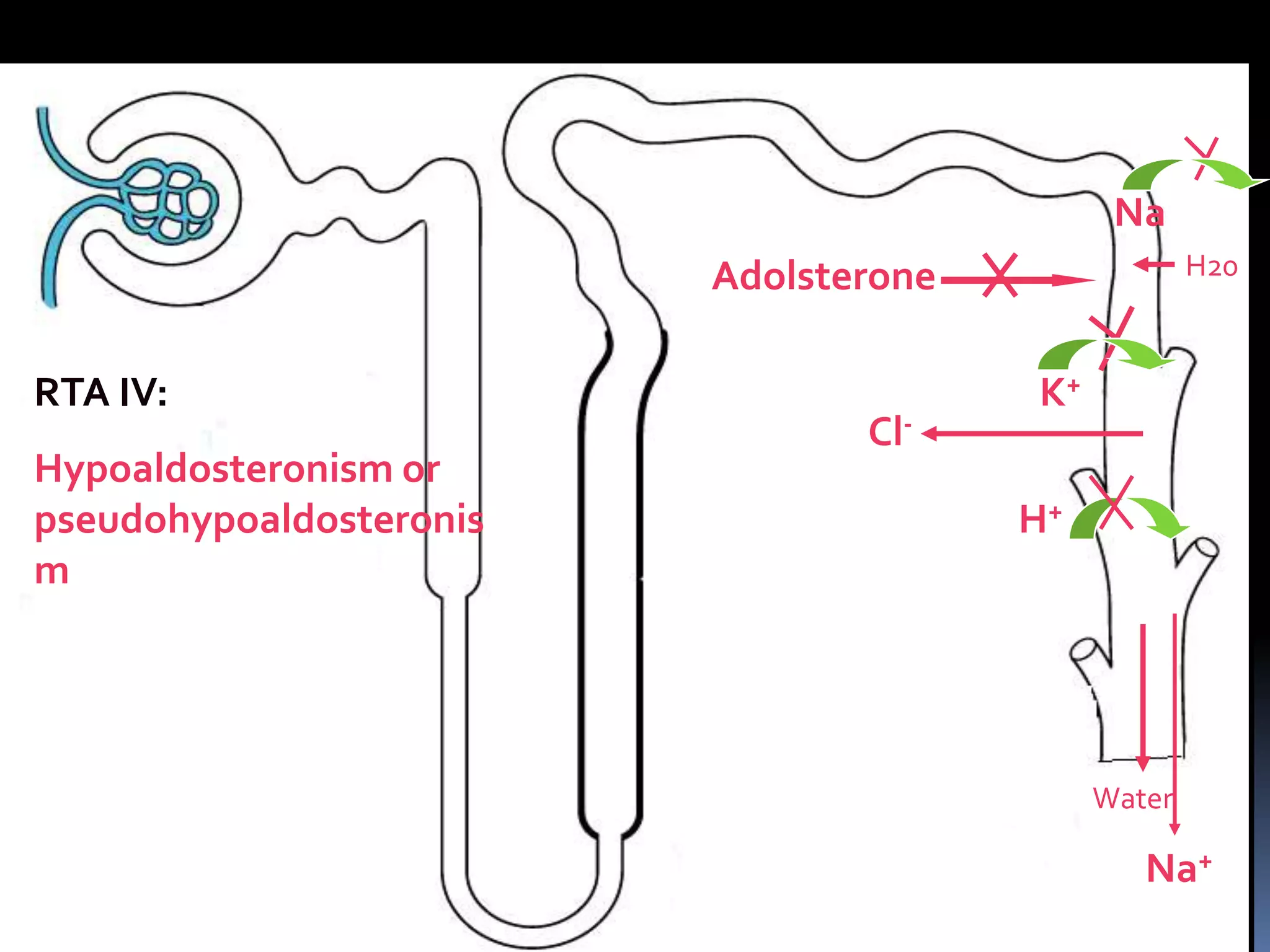 Adolsterone
Water
K+
Na
Na+
H+
Cl-
RTA IV:
Hypoaldosteronism or
pseudohypoaldosteronis
m
H20
 