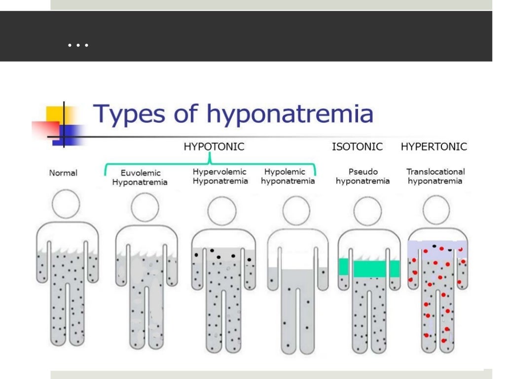 Approach To Hyponatremia