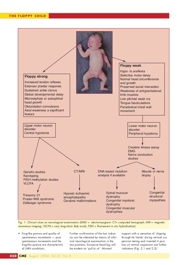 Approach to hypotonia