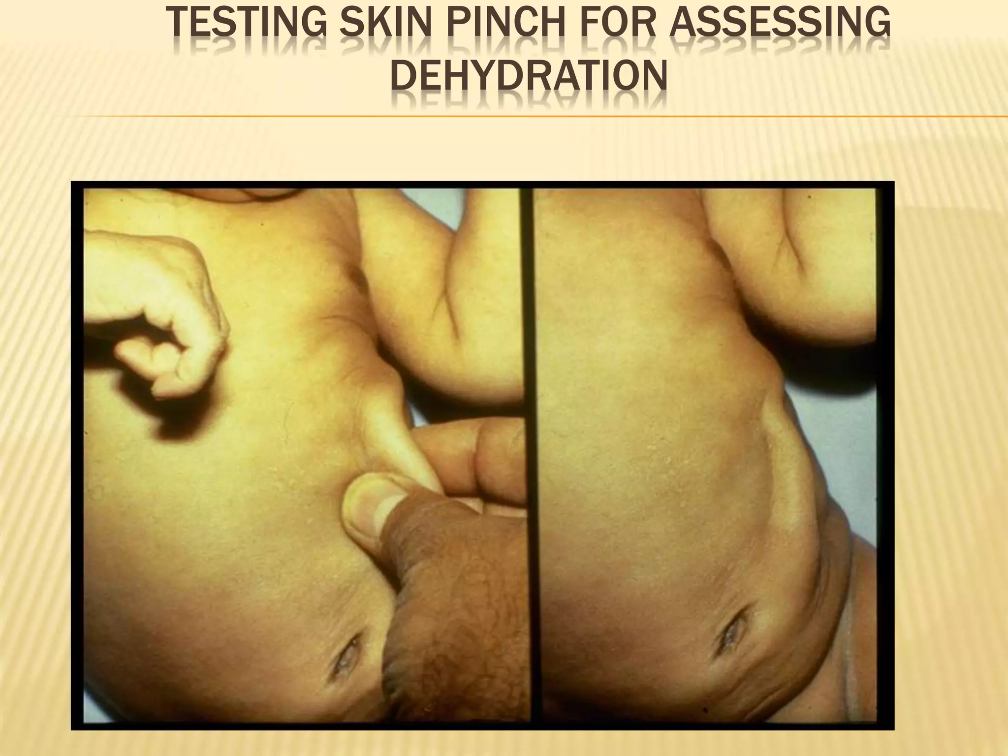 TESTING SKIN PINCH FOR ASSESSING 
DEHYDRATION 
 