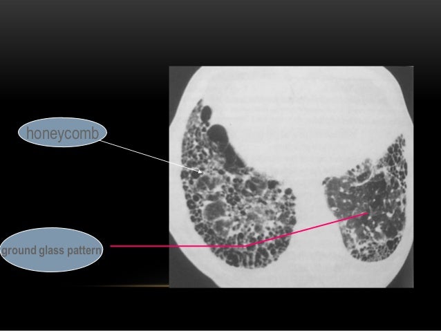 Approach to interstitial lung disease