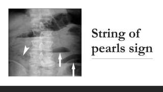 Approach to intestinal obstructions.pptx