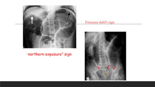 Approach to intestinal obstructions.pptx