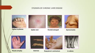Palmar erythema Spider nevi Parotid enlarged Gynecomastia
Muscle atrophy Asterixis Dupuytren’s contracture LL edema
STIGMATA OF CHRONIC LIVER DISEASE
 