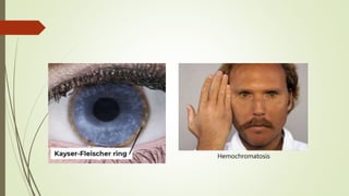 Hemochromatosis
 