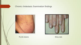 Chronic cholestasis: Examination findings
Pruritic lesions Shiny nails
 