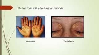 Xanthomas Xanthelasma
Chronic cholestasis: Examination findings
 