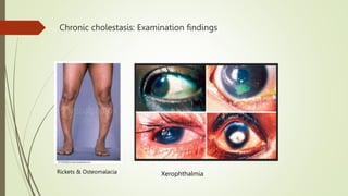 Rickets & Osteomalacia Xerophthalmia
Chronic cholestasis: Examination findings
 